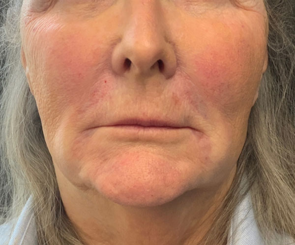 Botox Before and After | Montilla Plastic Surgery