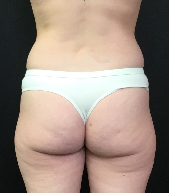Brazilian Butt Lift Before and After | Montilla Plastic Surgery