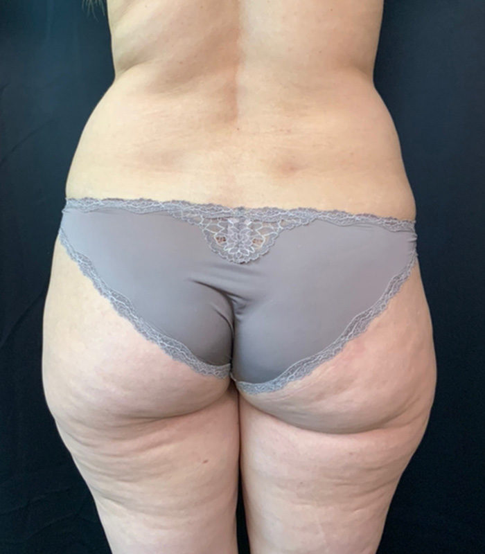 Brazilian Butt Lift Before and After | Montilla Plastic Surgery