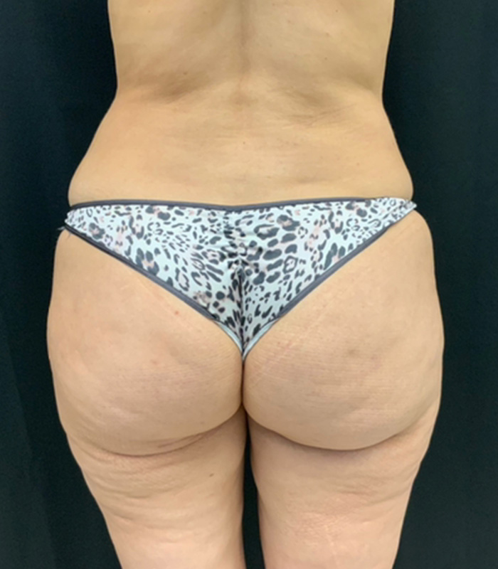 Brazilian Butt Lift Before and After | Montilla Plastic Surgery
