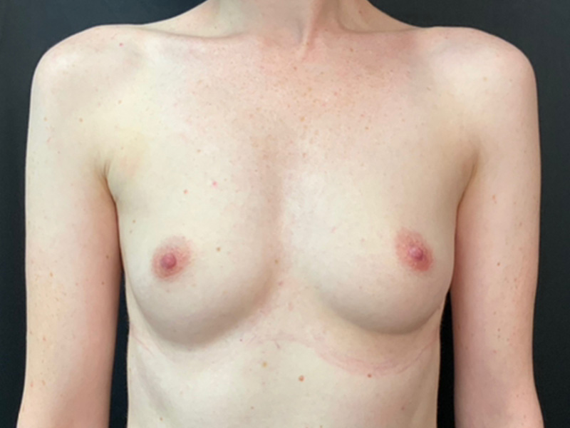 Breast Augmentation Before and After | Montilla Plastic Surgery 