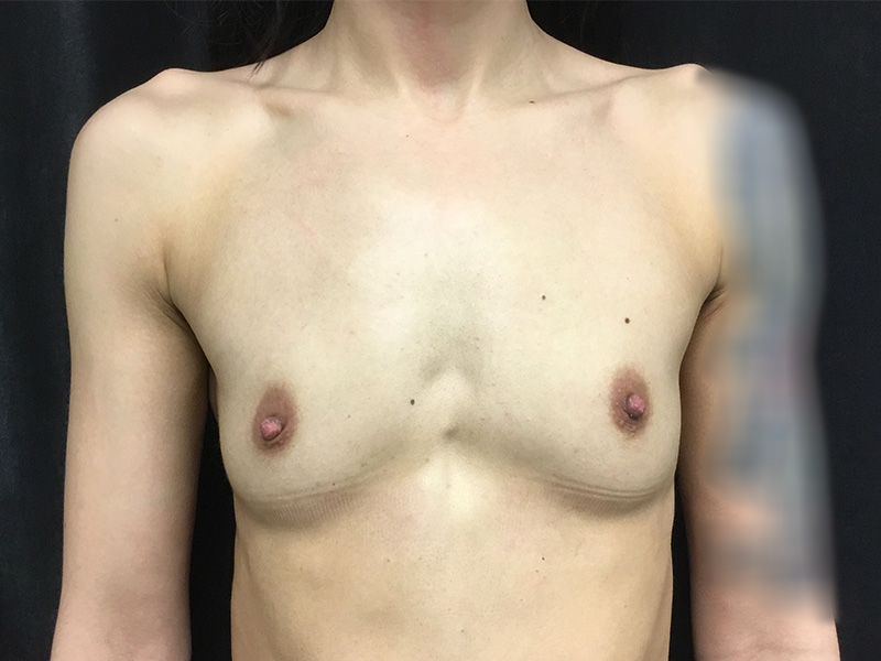 Breast Augmentation Before and After | Montilla Plastic Surgery 