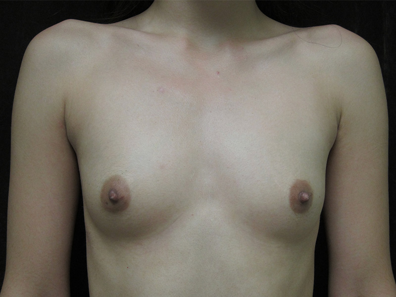 Breast Augmentation Before and After | Montilla Plastic Surgery 