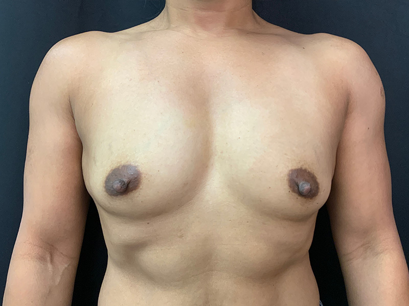 Breast Augmentation Before and After | Montilla Plastic Surgery 