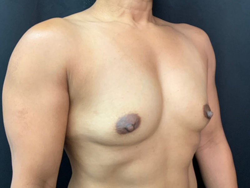 Breast Augmentation Before and After | Montilla Plastic Surgery
