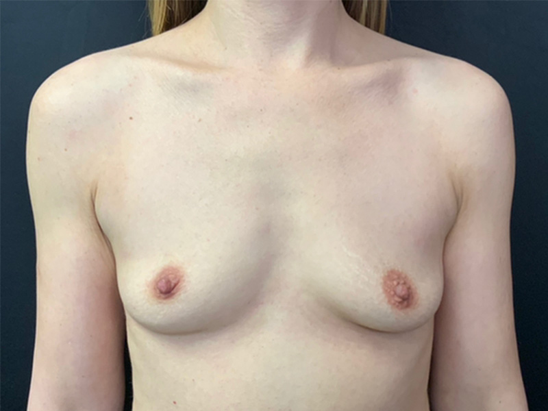 Breast Augmentation Before and After | Montilla Plastic Surgery 