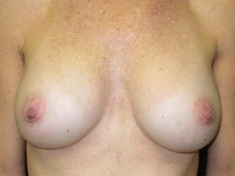 Breast Augmentation Before and After | Montilla Plastic Surgery 
