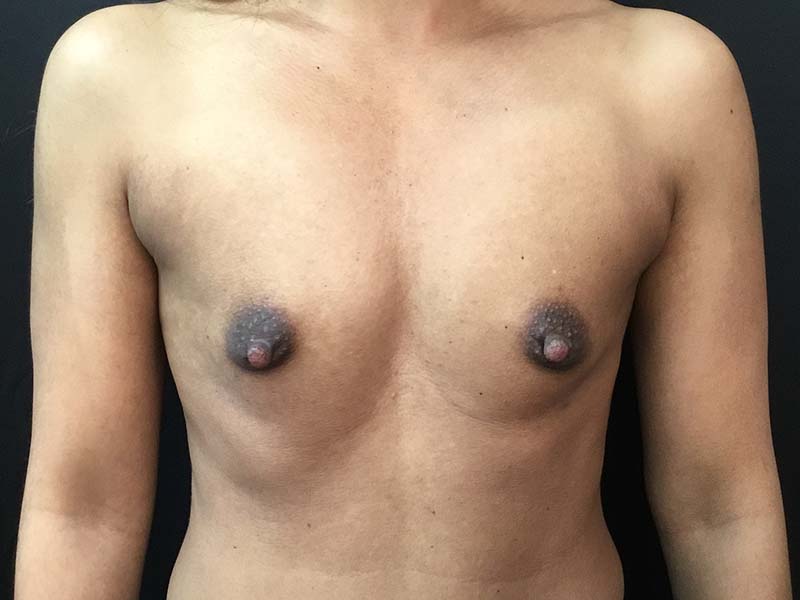 Breast Augmentation Before and After | Montilla Plastic Surgery 