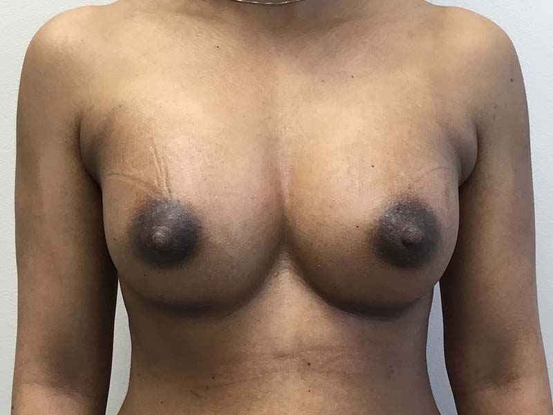 Breast Augmentation Before and After | Montilla Plastic Surgery 