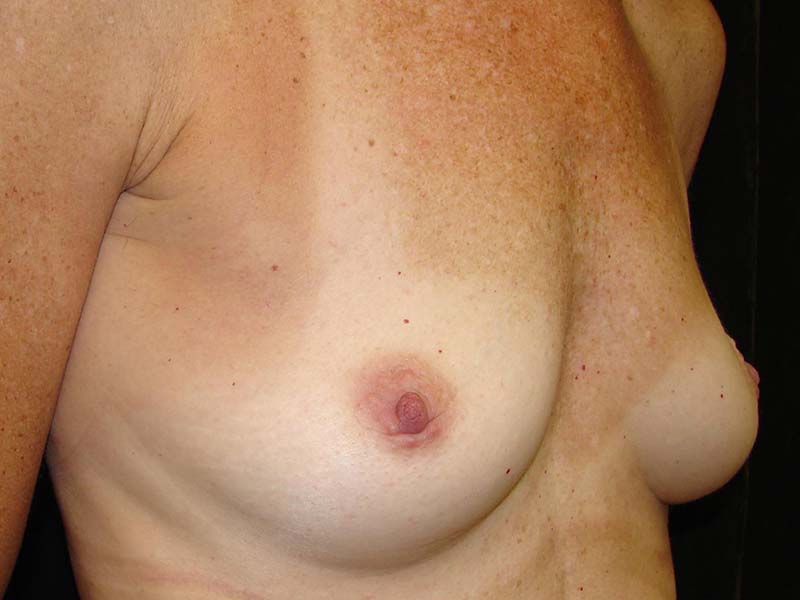 Breast Augmentation Before and After | Montilla Plastic Surgery