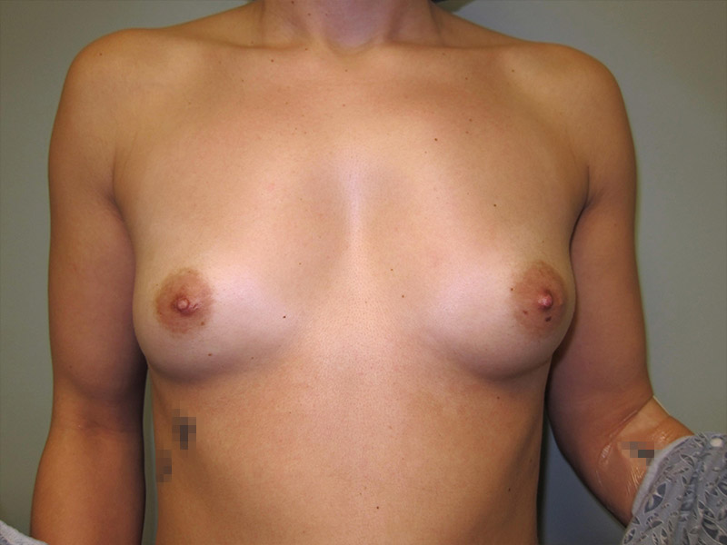 Breast Augmentation Before and After | Montilla Plastic Surgery 