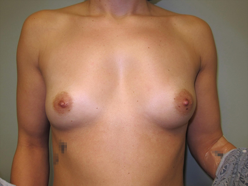 Breast Augmentation Before and After | Montilla Plastic Surgery