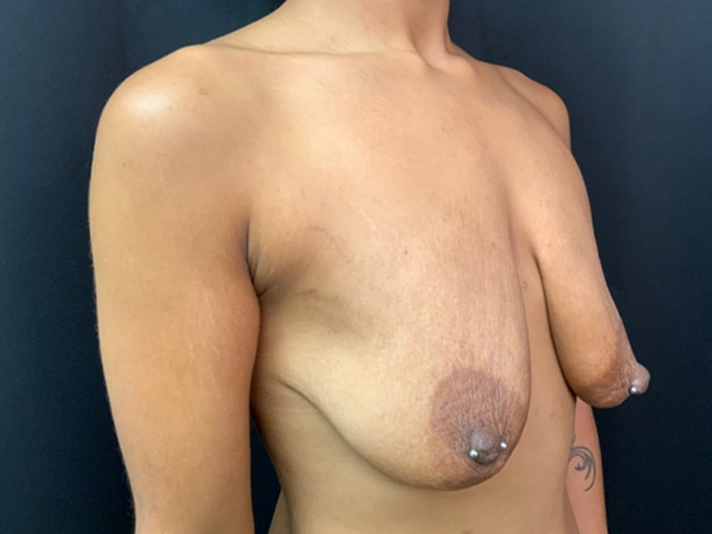 Breast Lift Before and After | Montilla Plastic Surgery