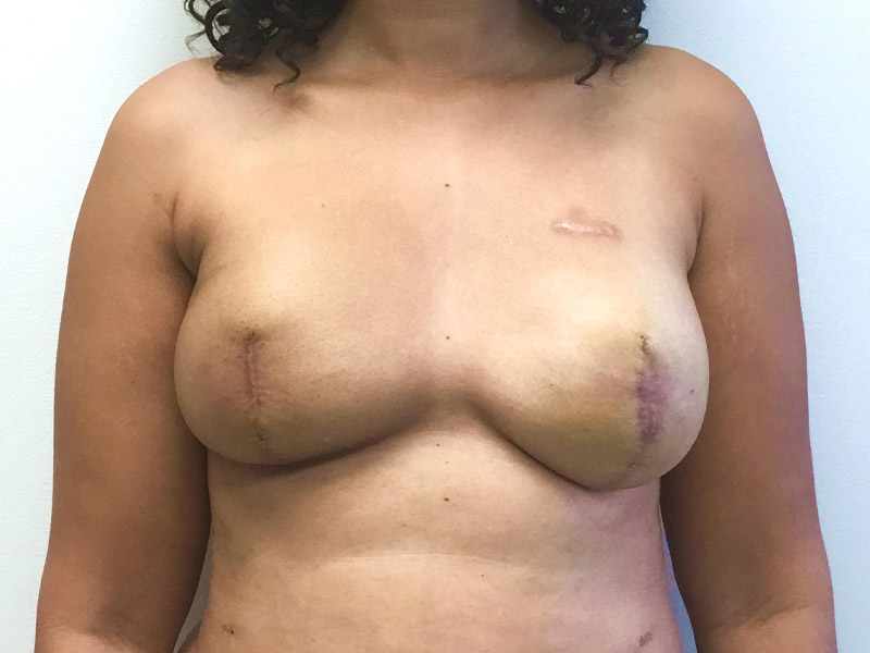Breast Reconstruction Before and After | Montilla Plastic Surgery 