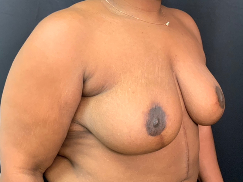 Breast Reduction Before and After | Montilla Plastic Surgery