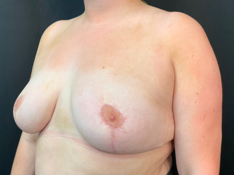 Breast Reduction Before and After | Montilla Plastic Surgery