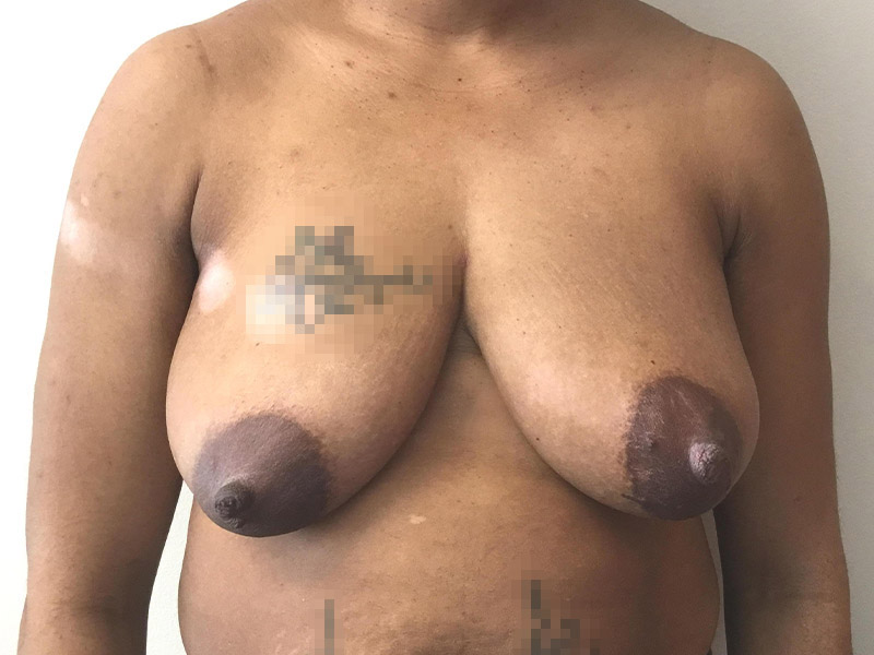 Breast Reduction Before and After | Montilla Plastic Surgery 