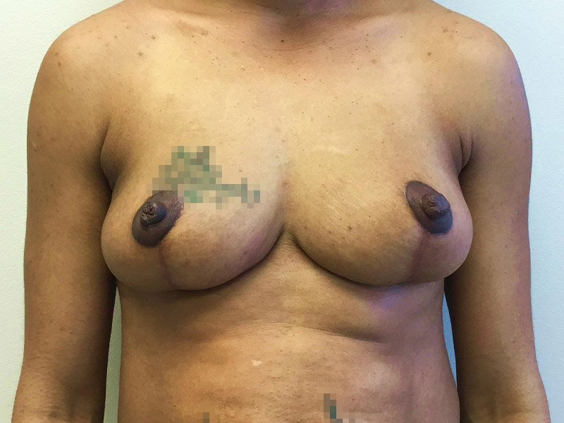 Breast Reduction Before and After | Montilla Plastic Surgery 