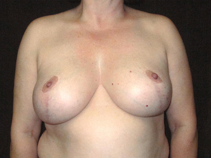 Breast Reduction Before and After | Montilla Plastic Surgery