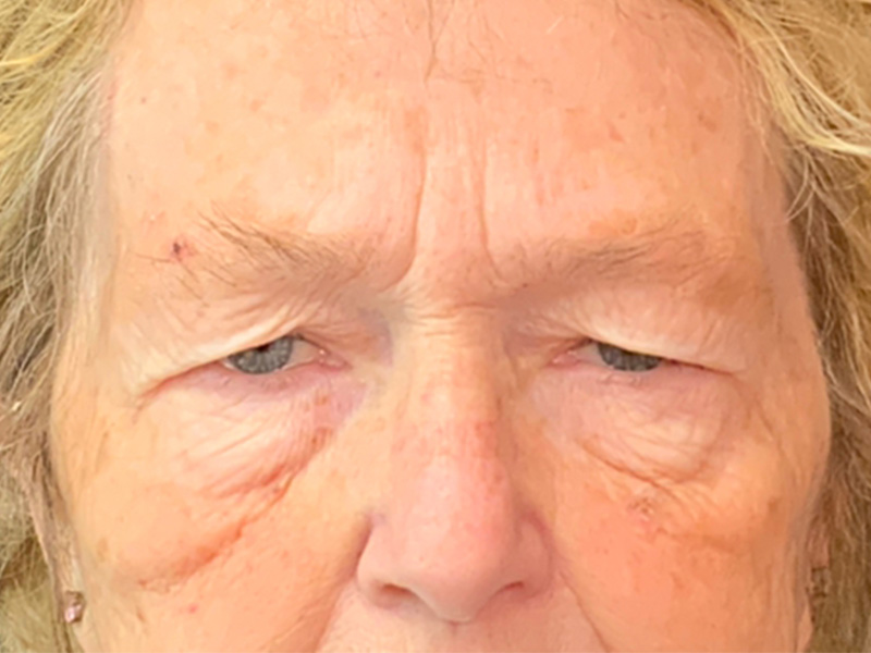 Brow Lift And Blepharoplasty Before and After | Montilla Plastic Surgery 