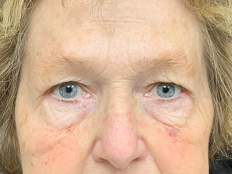 Brow Lift And Blepharoplasty Before and After | Montilla Plastic Surgery 