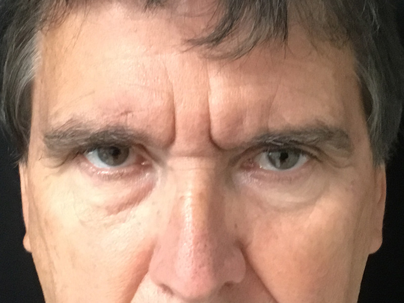 Brow Lift And Blepharoplasty Before and After | Montilla Plastic Surgery 
