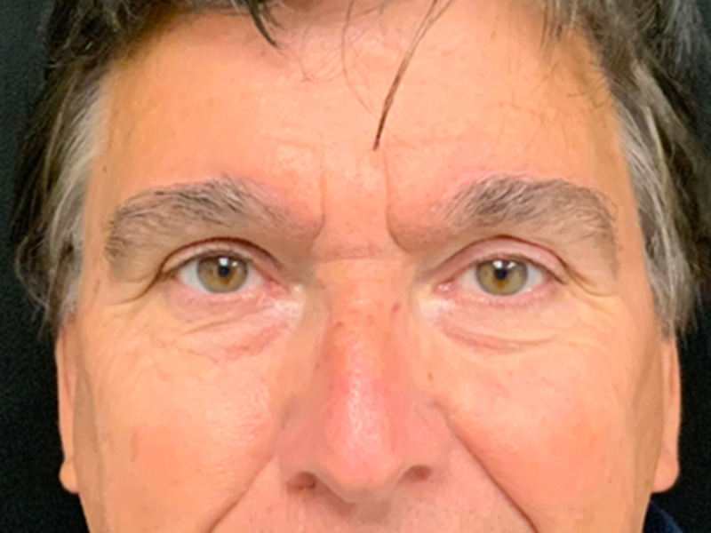 Brow Lift And Blepharoplasty Before and After | Montilla Plastic Surgery 
