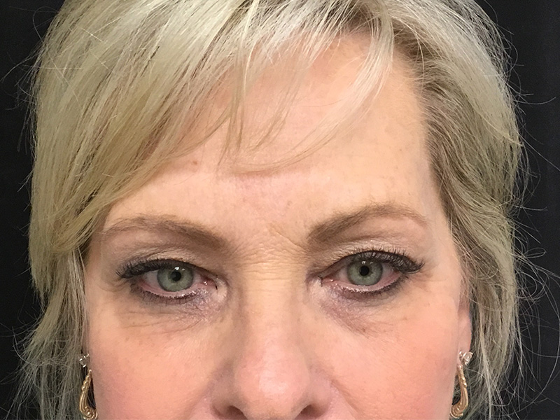 Brow Lift And Blepharoplasty Before and After | Montilla Plastic Surgery 