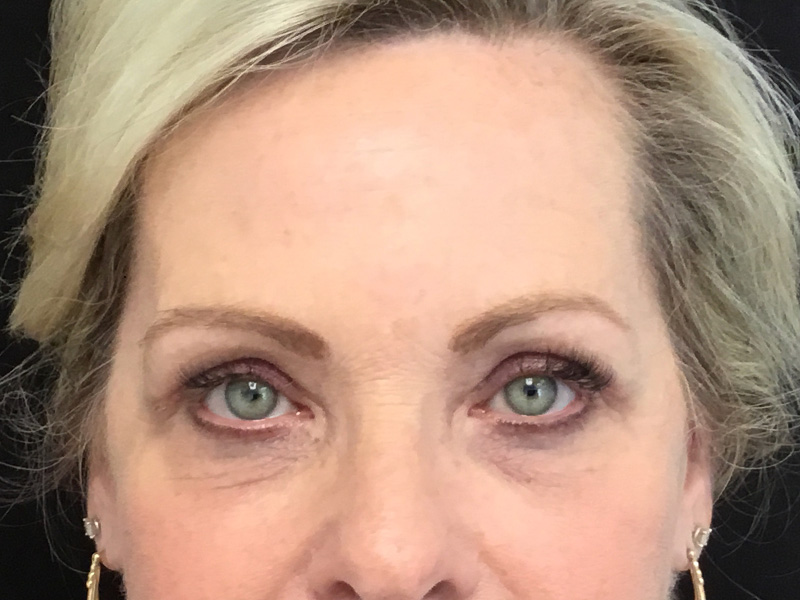 Brow Lift And Blepharoplasty Before and After | Montilla Plastic Surgery 