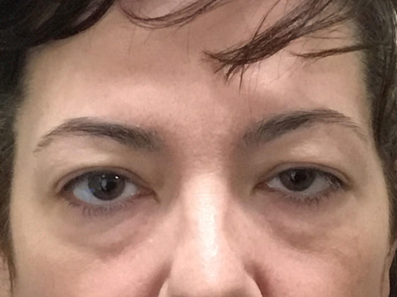 Brow Lift And Blepharoplasty Before and After | Montilla Plastic Surgery 