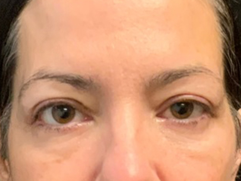 Brow Lift And Blepharoplasty Before and After | Montilla Plastic Surgery 