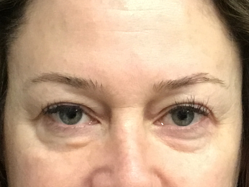 Brow Lift And Blepharoplasty Before and After | Montilla Plastic Surgery 