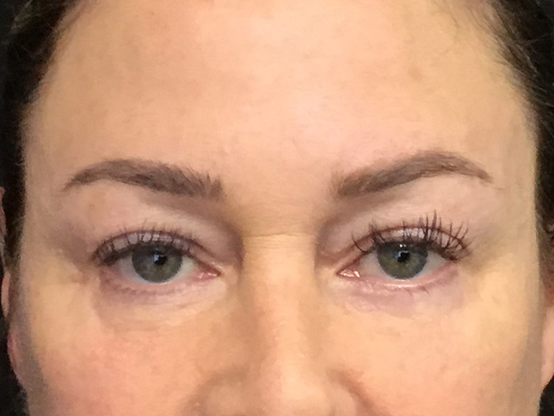 Brow Lift And Blepharoplasty Before and After | Montilla Plastic Surgery 