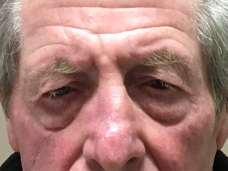 Brow Lift And Blepharoplasty Before and After | Montilla Plastic Surgery 