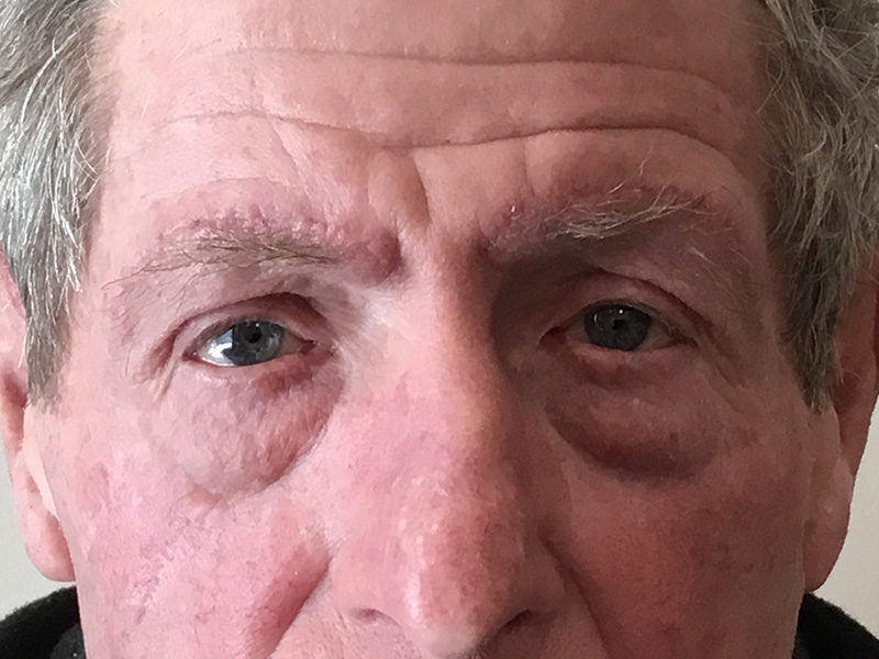 Brow Lift And Blepharoplasty Before and After | Montilla Plastic Surgery 
