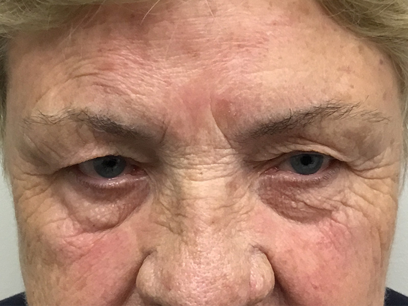 Brow Lift And Blepharoplasty Before and After | Montilla Plastic Surgery 