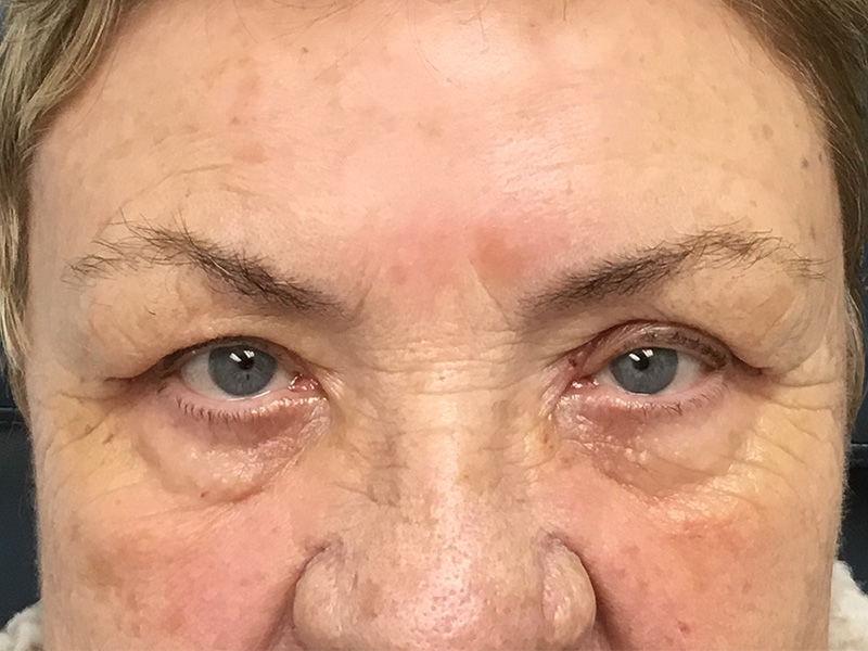 Brow Lift And Blepharoplasty Before and After | Montilla Plastic Surgery 