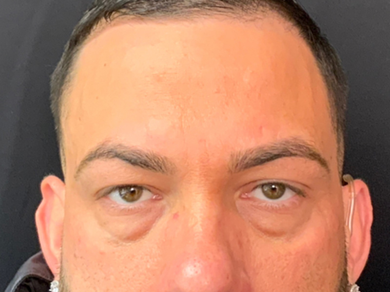 Brow Lift And Blepharoplasty Before and After | Montilla Plastic Surgery 
