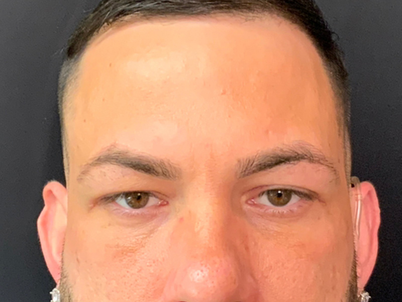 Brow Lift And Blepharoplasty Before and After | Montilla Plastic Surgery 