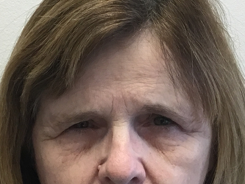 Brow Lift And Blepharoplasty Before and After | Montilla Plastic Surgery 