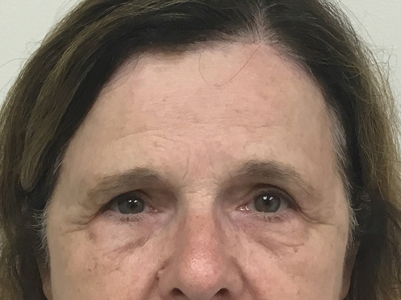 Brow Lift And Blepharoplasty Before and After | Montilla Plastic Surgery 