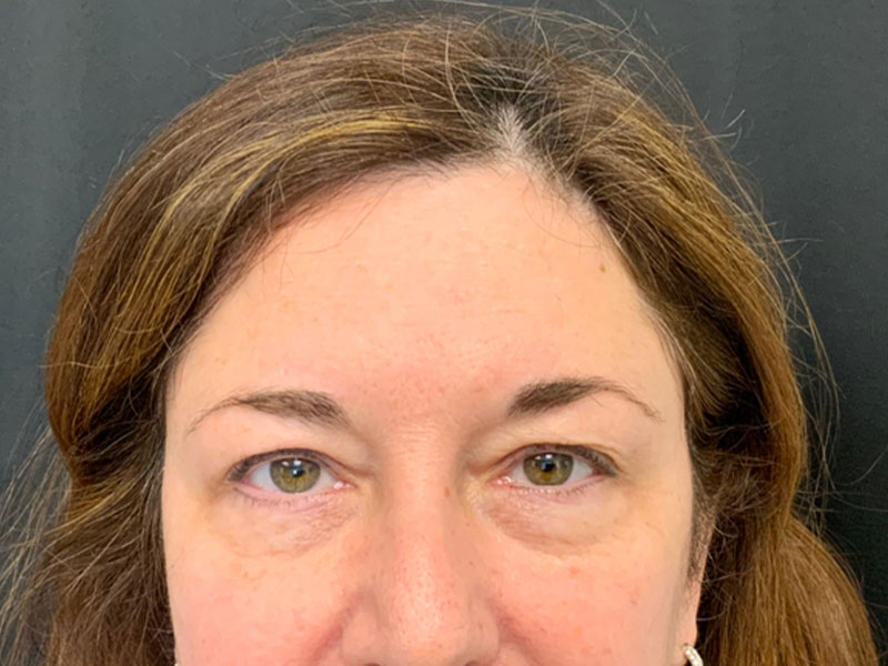Brow Lift And Blepharoplasty Before and After | Montilla Plastic Surgery 