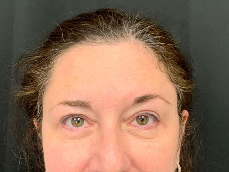 Brow Lift And Blepharoplasty Before and After | Montilla Plastic Surgery 