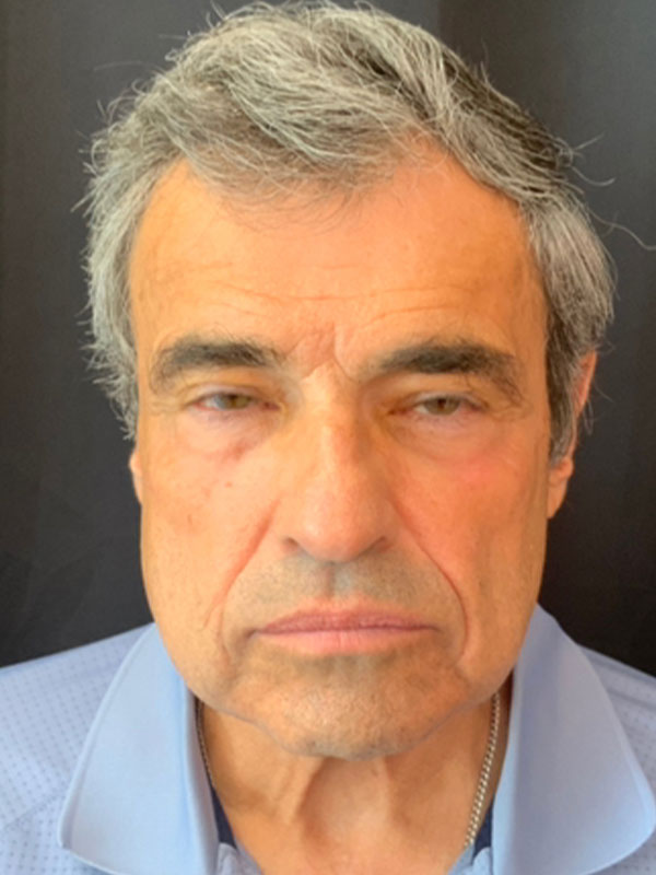 Brow Lift And Blepharoplasty Before and After | Montilla Plastic Surgery 