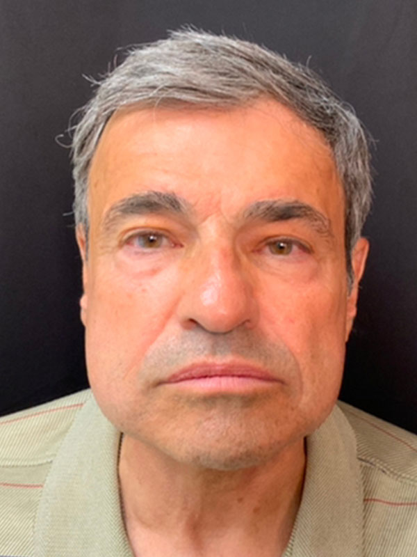 Brow Lift And Blepharoplasty Before and After | Montilla Plastic Surgery 