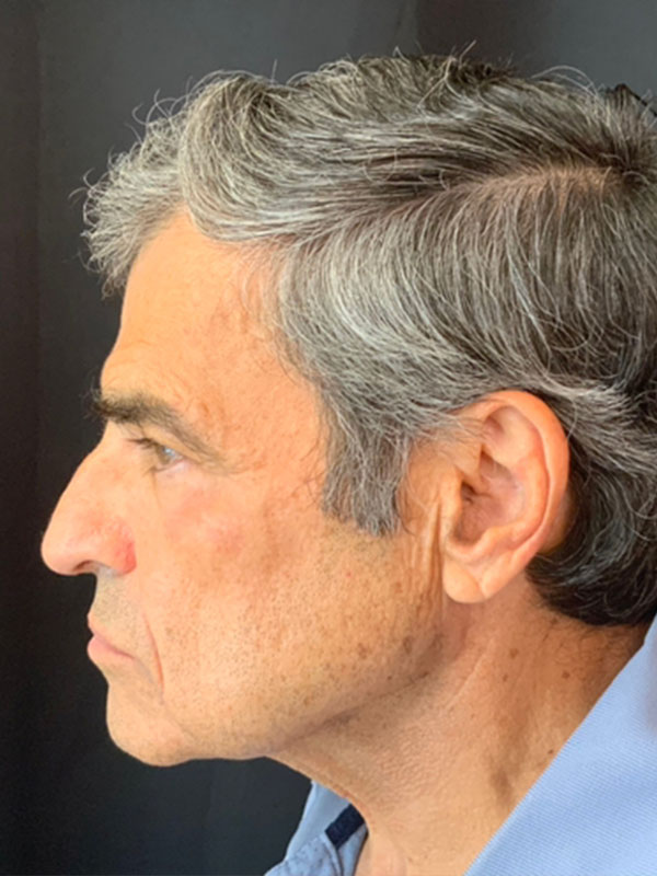 Brow Lift And Blepharoplasty Before and After | Montilla Plastic Surgery