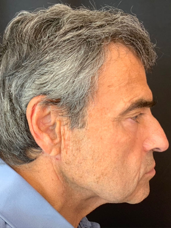 Brow Lift And Blepharoplasty Before and After | Montilla Plastic Surgery