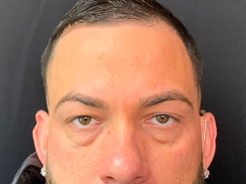 Brow Lift And Blepharoplasty Before and After | Montilla Plastic Surgery 