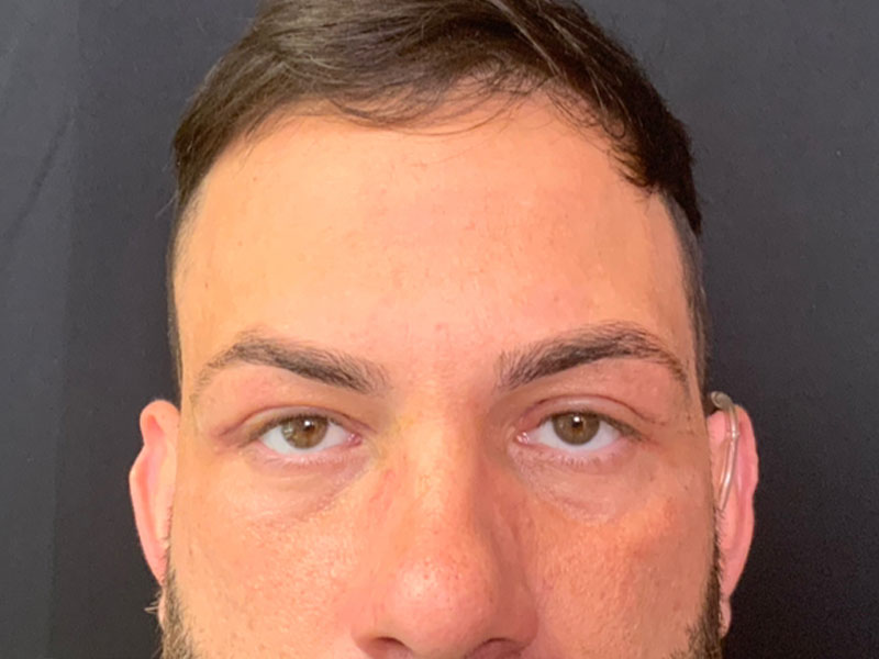 Brow Lift And Blepharoplasty Before and After | Montilla Plastic Surgery 