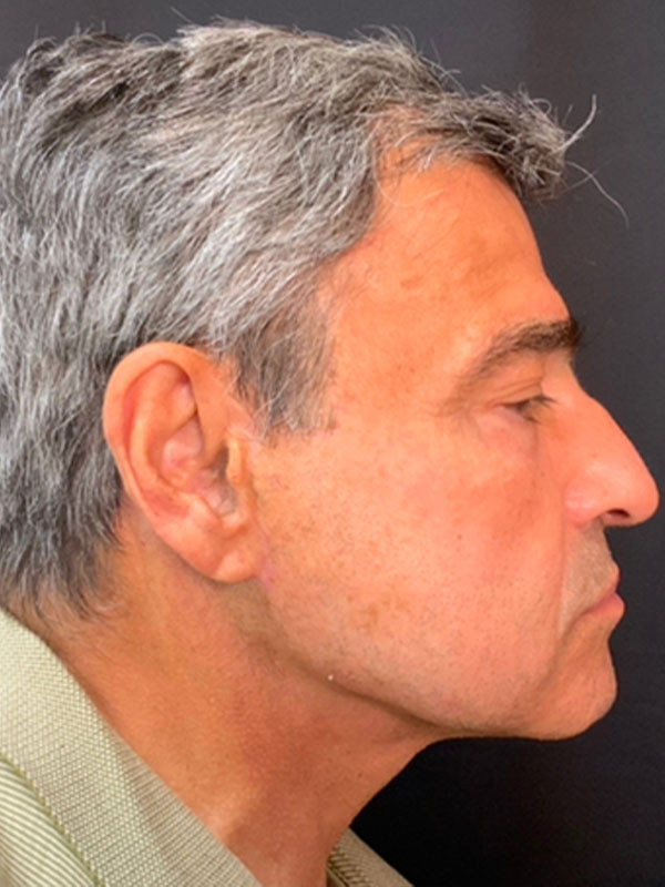 Brow Lift And Blepharoplasty Before and After | Montilla Plastic Surgery